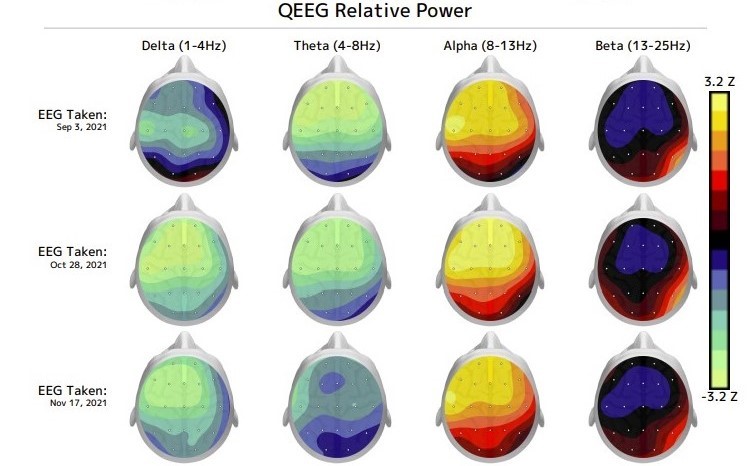 EEG report for Synapse Hawaii